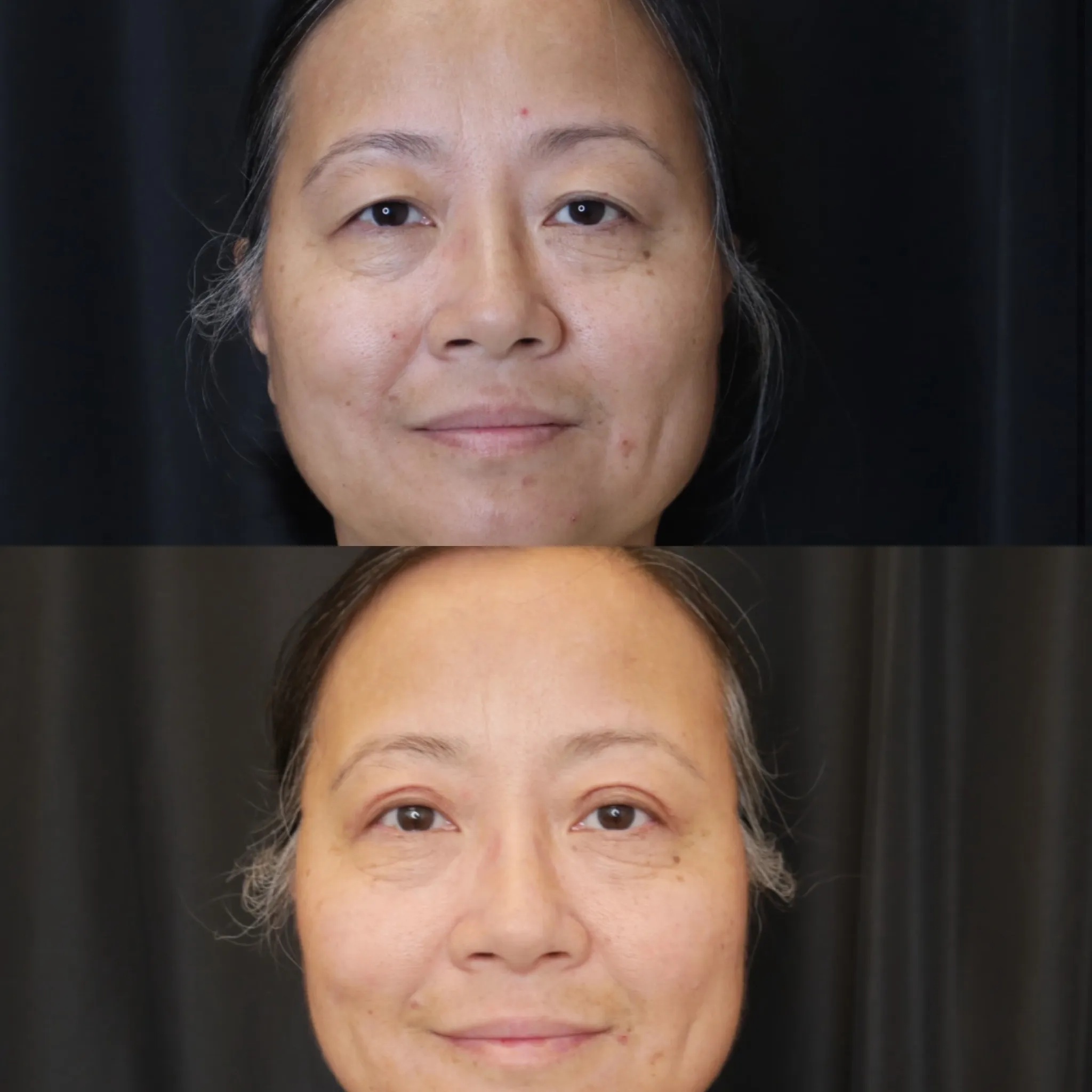 Upper Blepharoplasty, before and after, patient of Dr. Christine Bokman