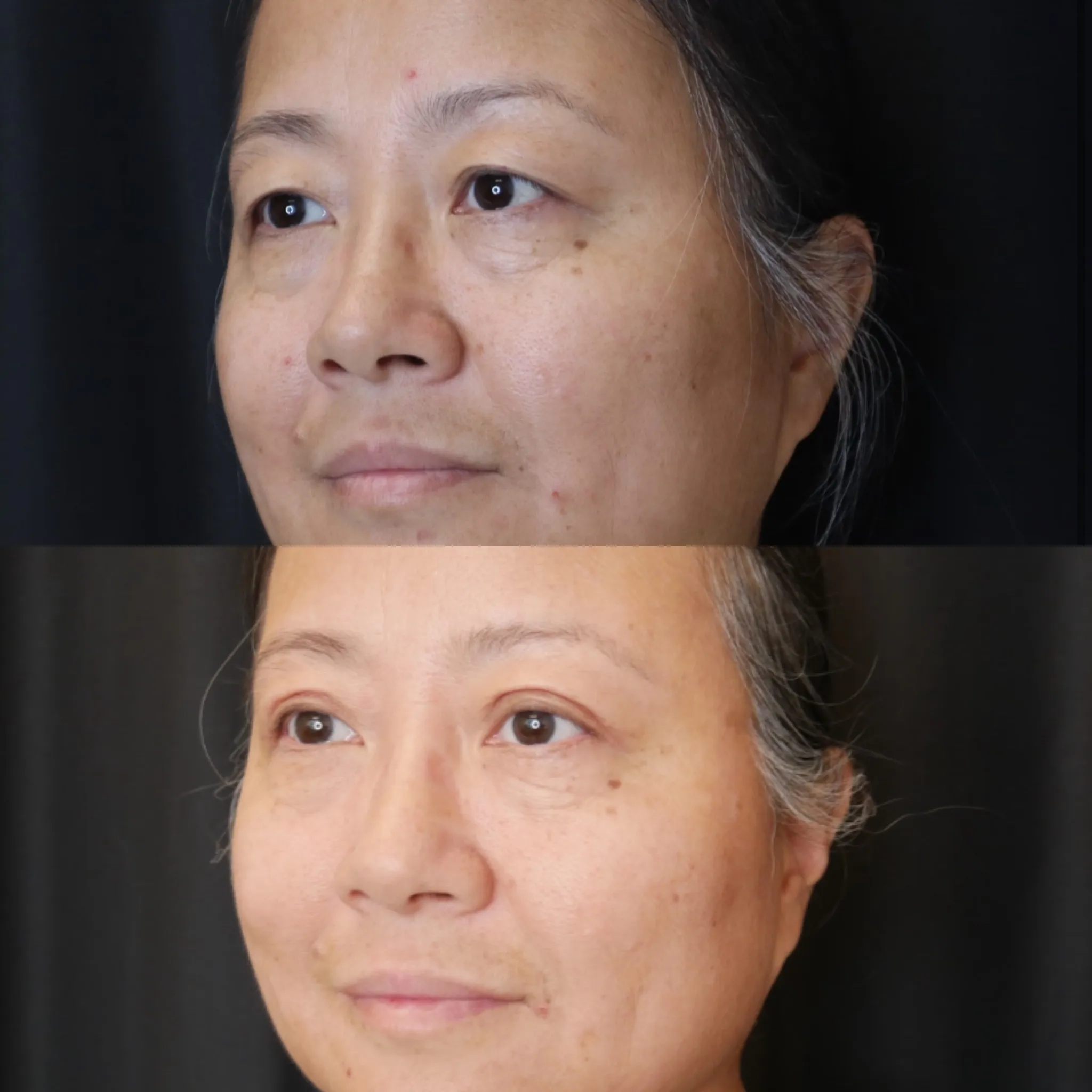 Upper Blepharoplasty, before and after, patient of Dr. Christine Bokman