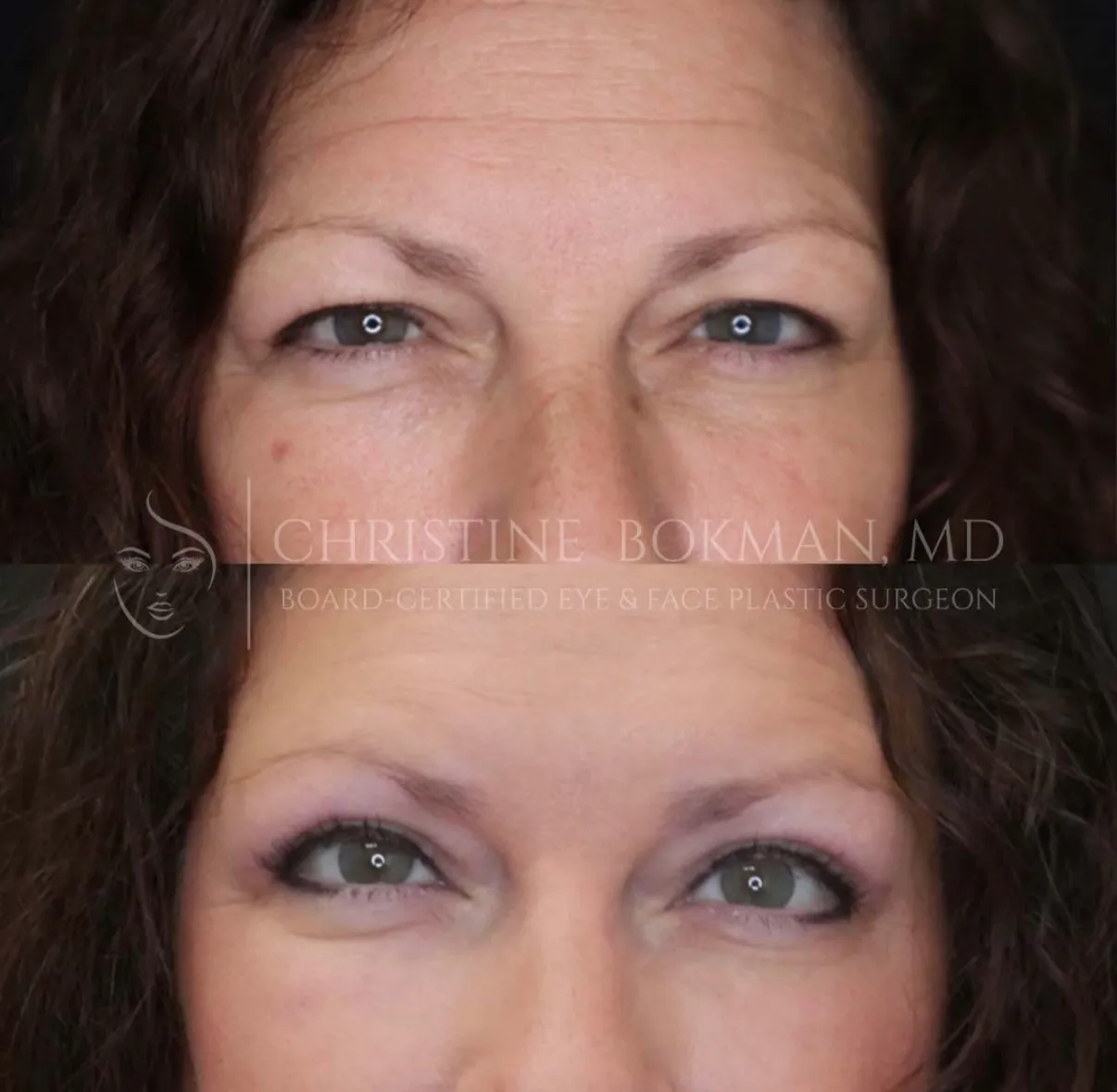 Upper Blepharoplasty, before and after, patient of Dr. Christine Bokman