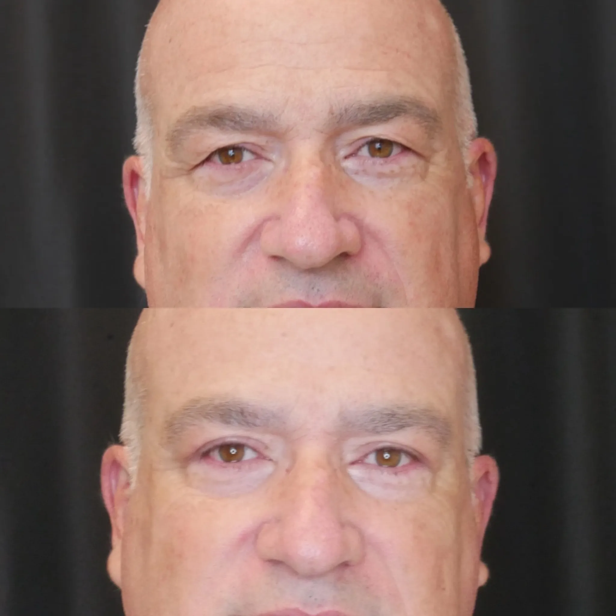 Upper Blepharoplasty, before and after, patient of Dr. Christine Bokman